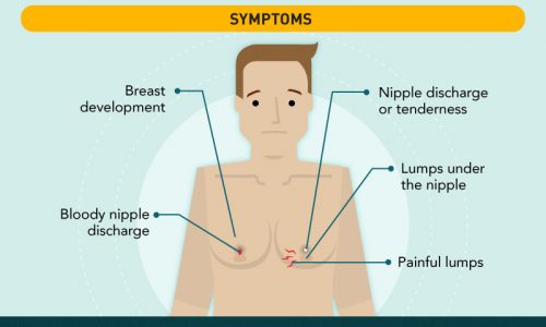 Man Boobs Gynecomastia Treatment Infographic